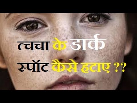 त्चचा के डार्क स्पॉट कैसे हटाए? जाने इस खबर से