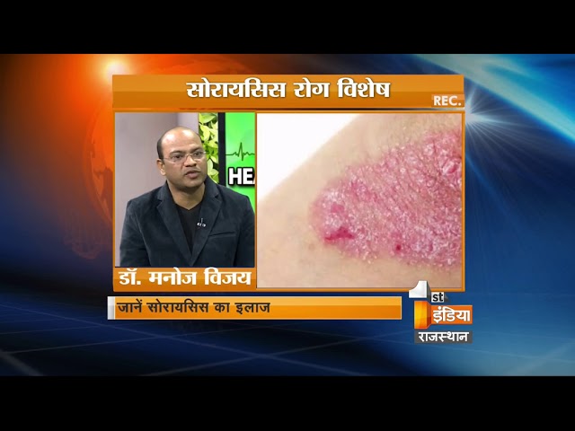 सोरायसिस क्या है? || What is psoriasis?