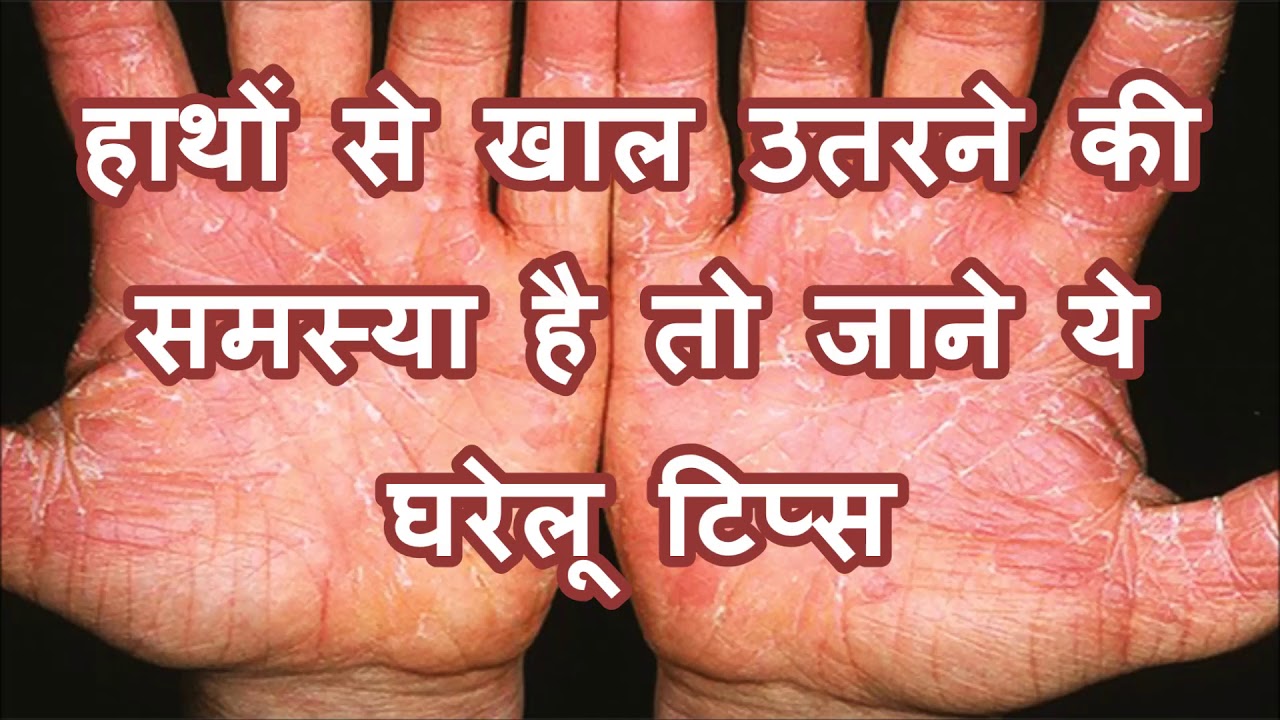 हाथों से खाल उतरने की समस्या है तो जाने ये घरेलू टिप्स || Skin peeling problem