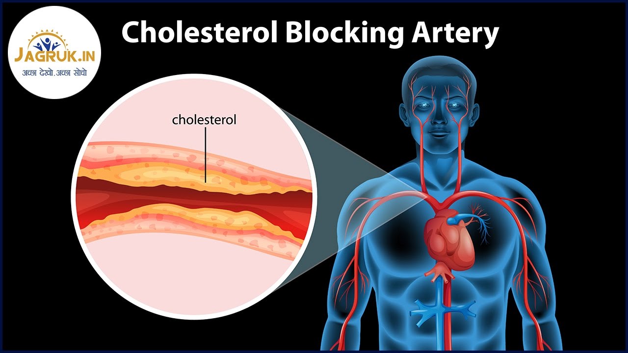 कोलेस्ट्रोल क्या है? | What Is Cholesterol in Hindi